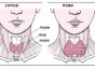 甲状腺癌术后能活多久